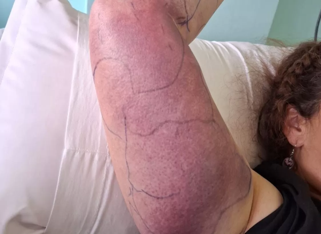 Mujer sufrió mareos y convulsiones tras ser mordida por una culebra…